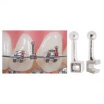 Attachments Archwire Hooks Split Ball Hooks – Open & Closed