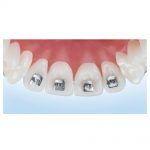 Fixed Appliances Tongue Tamer Tongue-Tamers