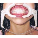 Bonding Supplies  High Heat Cheek Retractor