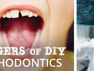 Dangers of DIY Orthodontics