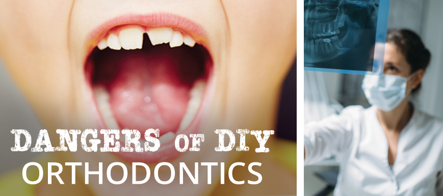 Dangers of DIY Orthodontics