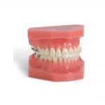 Aesthetic Brackets Reflections Ceramic Bracket System Reflections Typodont