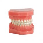 Aesthetic Brackets Encore! Metal-Lined Ceramic Bracket System Encore! Metal-Lined Ceramic Typodont