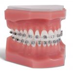 G50-360-Pinnacle-Typodont