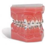 Metal Brackets Lotus Plus Self-Ligating Bracket System Lotus Plus Typodonts