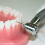 Interproximal-Diamond-Burs-In-Use