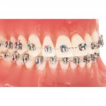 Lotus-PLUS-DS-Typodont-Closeup