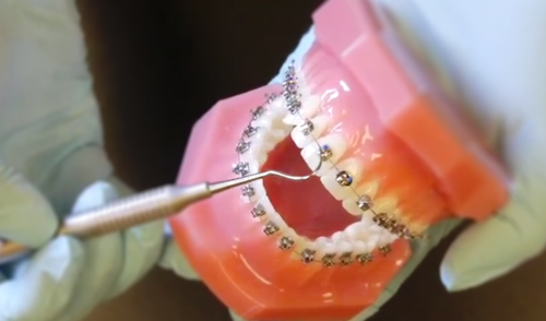 Lotus Plus DS Self-Ligating Bracket System