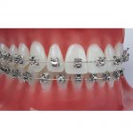 SensationM-Typodont-Closeup