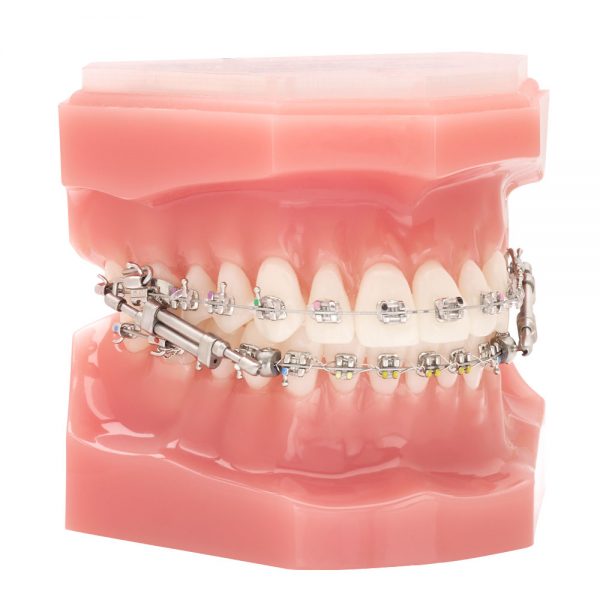 TruEase Bite Corrector Typodont