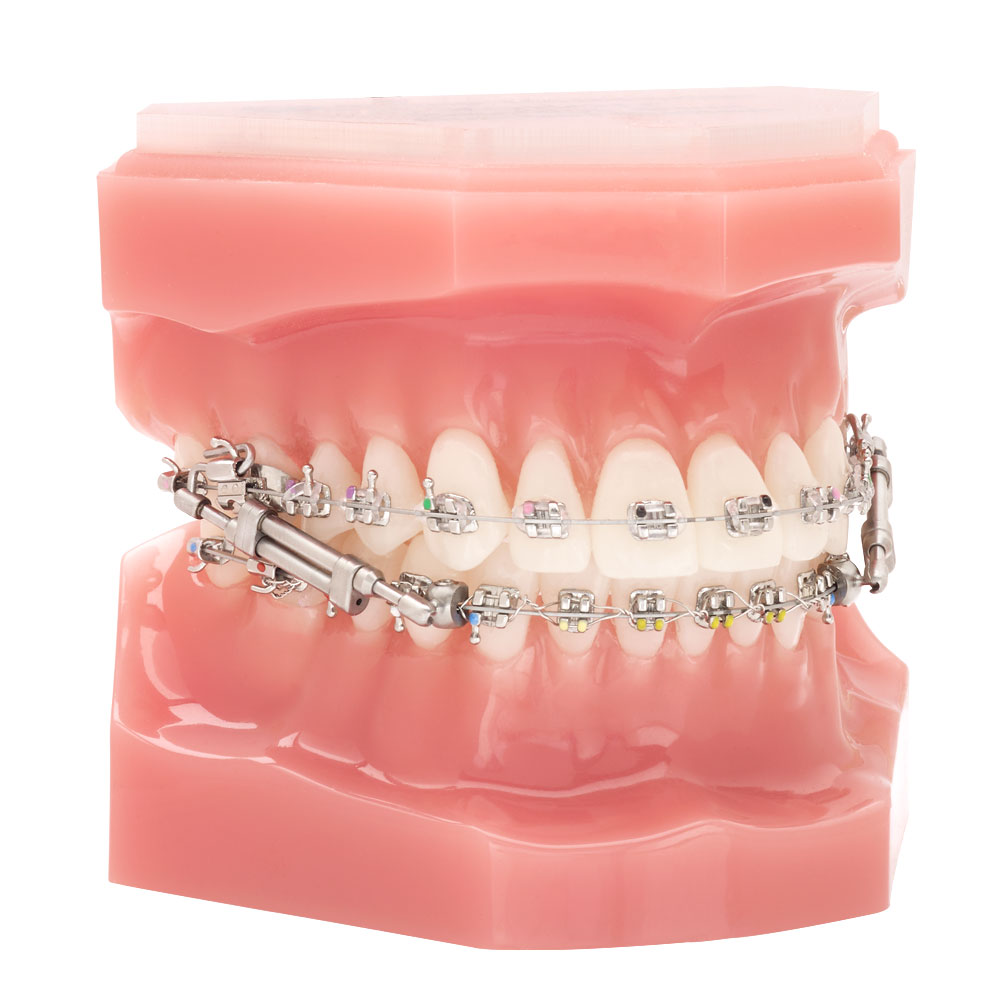 TruEase Bite Corrector Typodont