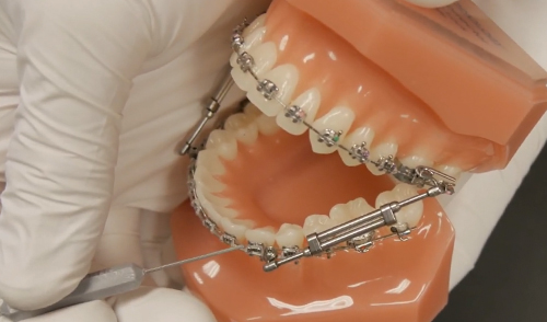 TruEase Bite Corrector Devices