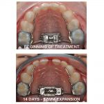 TruEase-Rapid-Palatal-Expander-In-Use