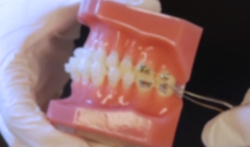 TruEase Bondable Buccal Tubes